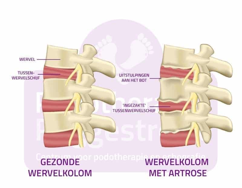 Artrose Rug Spondylartrose Podotherapie Reggestreek Rijssen Artrose Rug Spondylartrose Podotherapie Reggestreek Rijssen