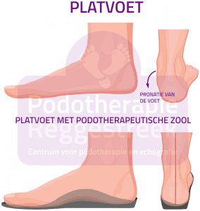 Platvoet Overpronatie Voet Sinus Tarsi Syndroom Podotherapie Reggestreek Rijssen Platvoet Overpronatie Voet Sinus Tarsi Syndroom Podotherapie Reggestreek Rijssen