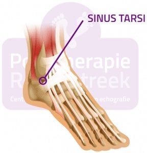 Sinus Tarsi Syndroom Podotherapie Reggestreek Rijssen Sinus Tarsi Syndroom Podotherapie Reggestreek Rijssen