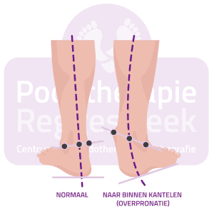 Stand van de voet pronatie normaal Hypermobiliteit Podotherapie Reggestreek Rijssen.png Stand van de voet pronatie normaal Hypermobiliteit Podotherapie Reggestreek Rijssen.png
