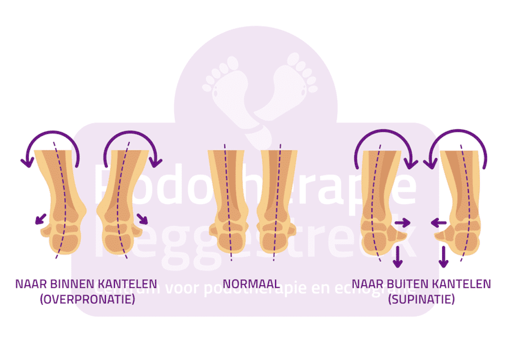 Stand Voet Normaal Valgisatie Varisatie Achillespeesklachten Achillespeesblessure Podotherapie Reggestreek Rijssen Stand Voet Normaal Valgisatie Varisatie Achillespeesklachten Achillespeesblessure Podotherapie Reggestreek Rijssen