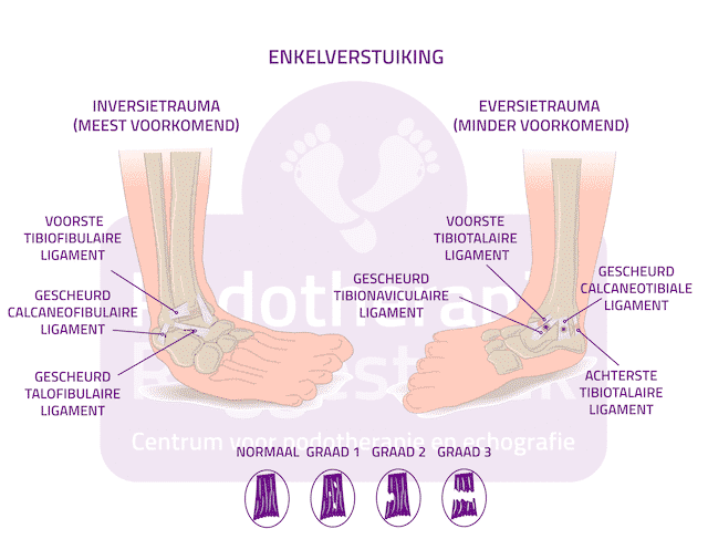 Enkelklachten Podotherapie Reggestreek Rijssen Enkelklachten Podotherapie Reggestreek Rijssen