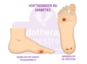 Voetwonden bij diabetes Wonbehandeling Podotherapie Reggestreek Rijssen Voetwonden bij diabetes Wonbehandeling Podotherapie Reggestreek Rijssen